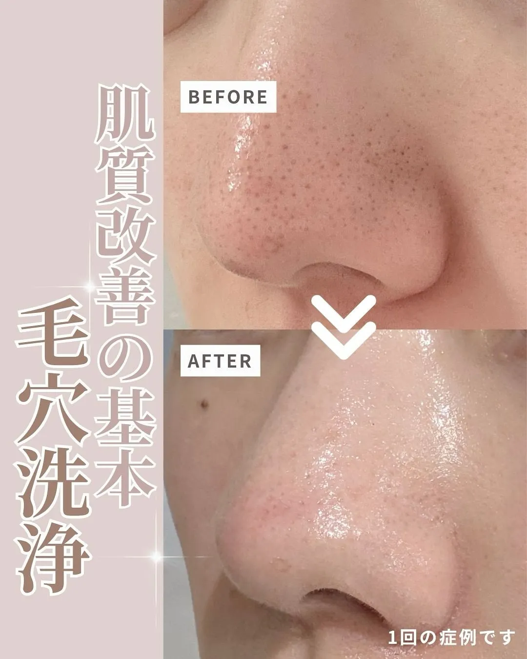 🌿 BIOピーリング(毛穴洗浄)とは?