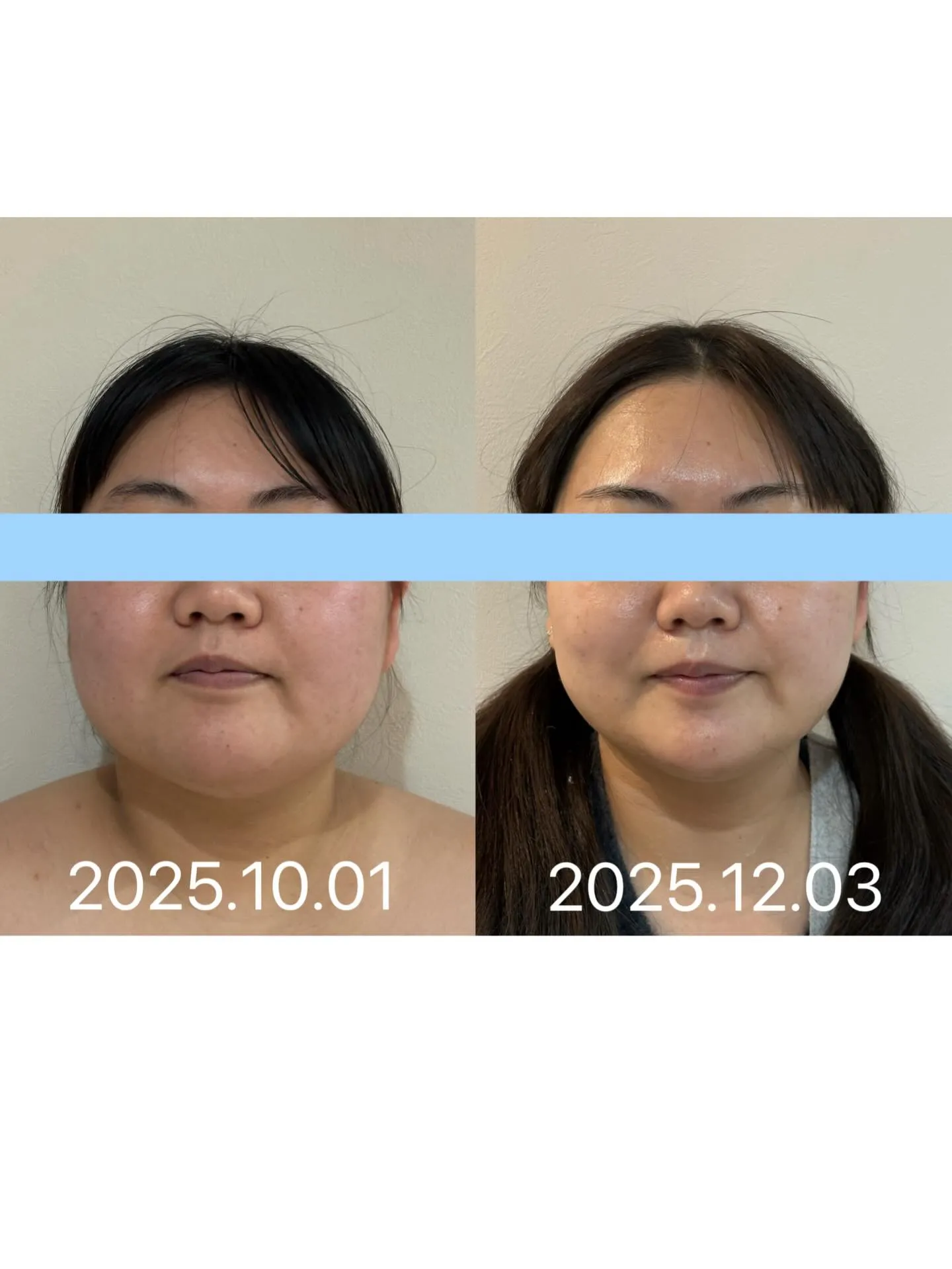 ✨ブライダルエステ卒業✨